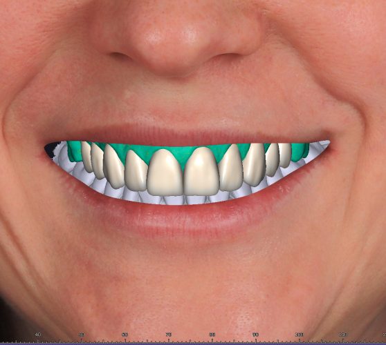 Digitaler Wax-Up anhand von Fotos (Smile Design)